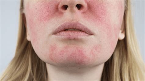 Tips For Managing Rosacea Flare Ups