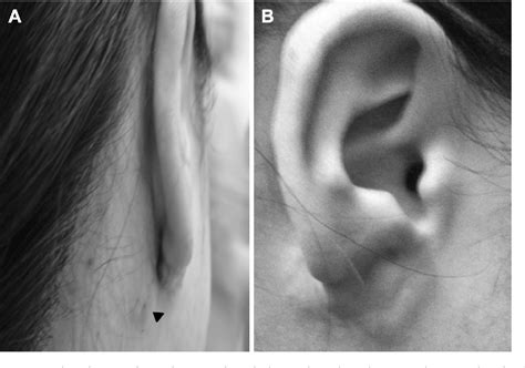 Figure 2 From Postauricular Flap Based On Dermal Pedicle For