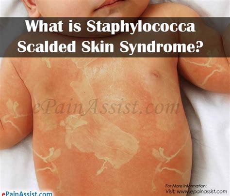What Is Staphylococcal Scalded Skin Syndromecauses