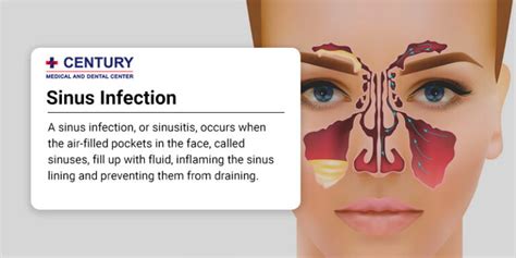 Are Sinus Infections Contagious Century Medical And Dental Center