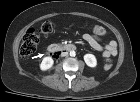 Ct Scan With Arrow Demonstrating Duodenal Wall Thickening And