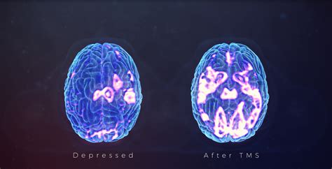 Depressed Vs After Tms Tms Center At Southeastern Psychiatric Associates