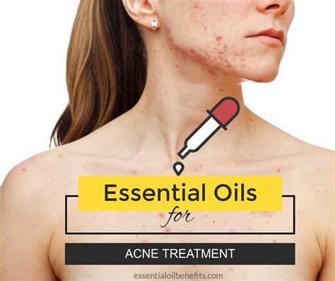Best Essential Oil Recipes For The Treatment Of Acne Essential Oil Benefits