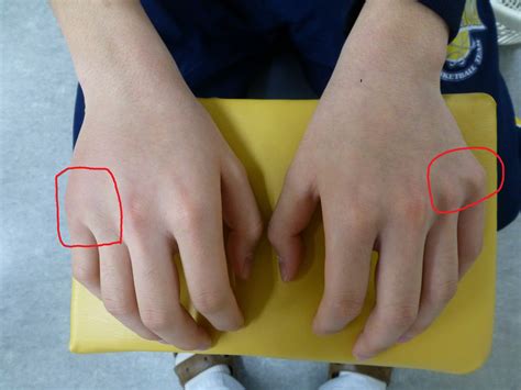 手のひらの骨の骨折