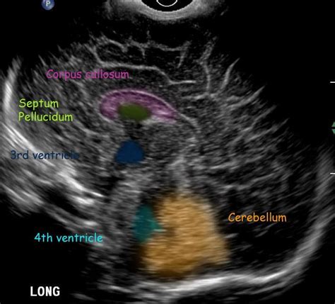 Neonatal Brain Sagittal Midline Neonatal Ultrasound Sonography Student