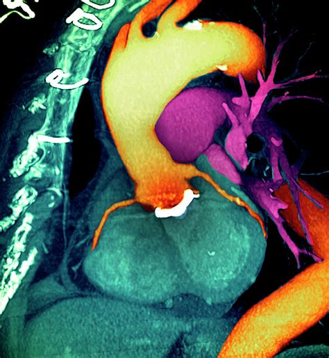Prosthetic Heart Valve Photograph By Zephyrscience Photo Library