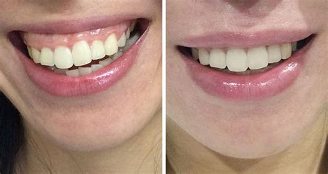 Gummy Smile Botox Dr Areeb Anwar