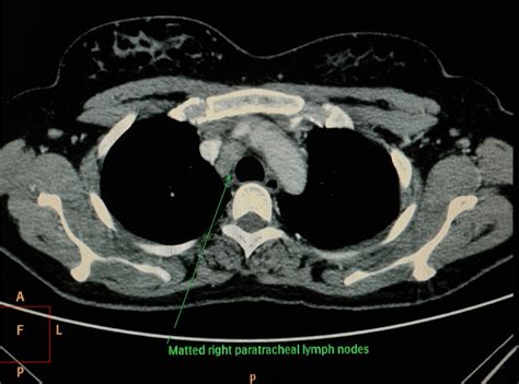 Computed Tomography Scan Of The Chest Showing Mediastinal