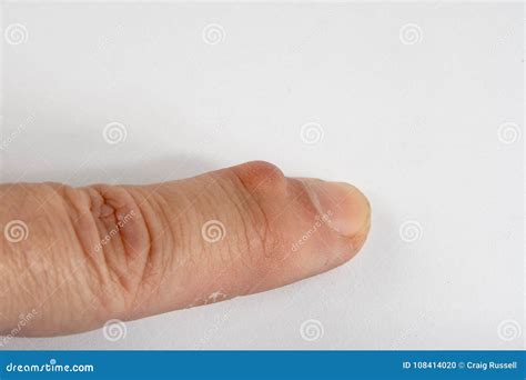 Mucous Cyst Ganglion Of The Finger Youtube Vrogue Co
