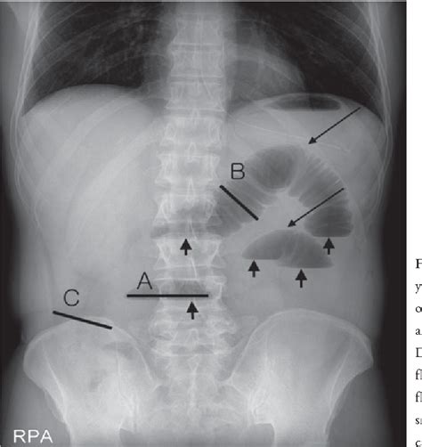 Figure 1 From Accuracy Of Plain Abdominal Radiography In The