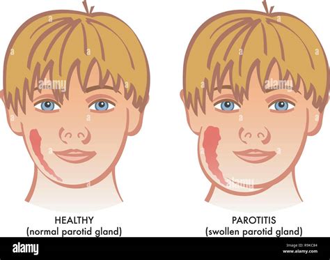 A Vector Medical Illustration Showing A Healthy Child Next To On