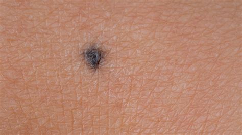 What You Should Do If You Find A Blue Nevus Mole On Your Body