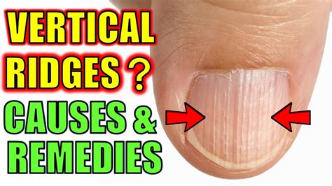 Do You Have Vertical Ridges On Your Nails Causes And Natural Cures