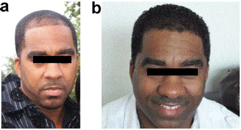 Justin said his facial hair transplant was so perfect it can take a couple of hours to most of the day, depending on how many hairs are transplanted. African American hair loss - what can be done?
