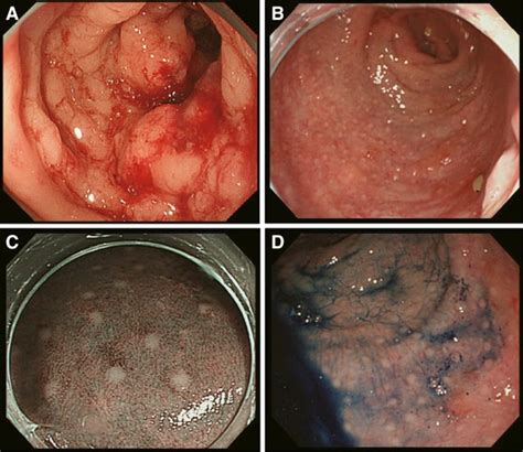 Endoscopically Observable White Nodule Caused By Distal Intramural