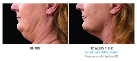 Coolsculpting Double Chin At Dm Cosmetic Clinic Woodbridge Vaughan
