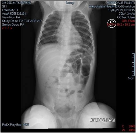 Plain Abdominal X Ray Showed Air Fluid Levels Download Scientific