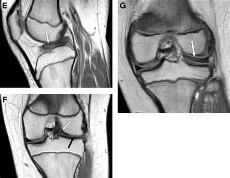 Arthroscopic Partial Meniscectomy With Repair Of The Peripheral Tear