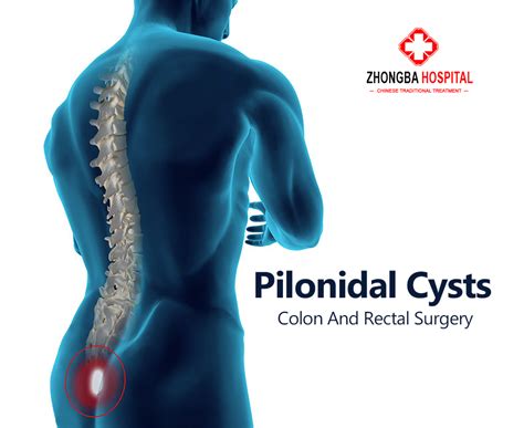 Pin By Zhongba Hospital Lahore On Anorectal Pilonidal Cyst Rectal Cysts