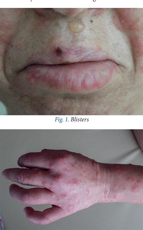 Figure 1 From Herpes Iris Erythema Multiforme Manifested After Human