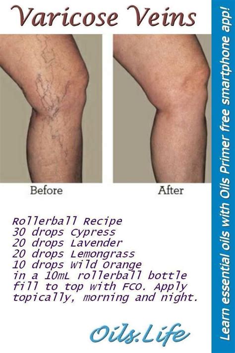Effective Home Remedies For The Natural Elimination Of Varicose Veins