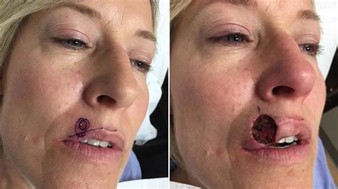Woman Mistakes Skin Cancer On Lip For Pimple