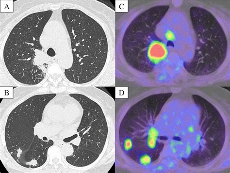 Pulmonary Epithelioid Haemangioendothelioma Mimicking Lung Cancer Bmj