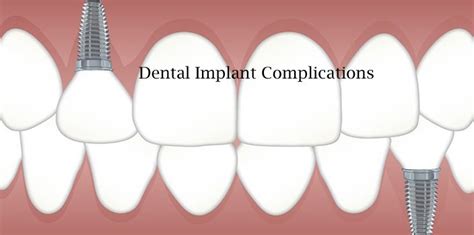 Dental Implant Complications And Failures
