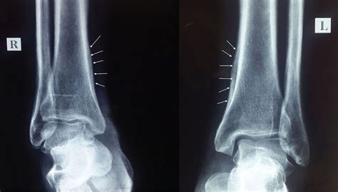 Hypertrophic Osteoarthropathy Uncommon Presentation Of Lung Cancer Cleveland Clinic Journal