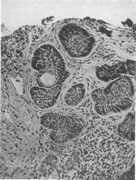 Multiple Nevoid Basal Cell Epithelioma Jaw Cysts And Bifid Rib — A
