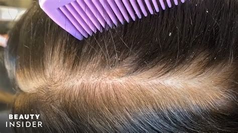 How Severe Dandruff Is Removed From The Scalp Insider Beauty Youtube