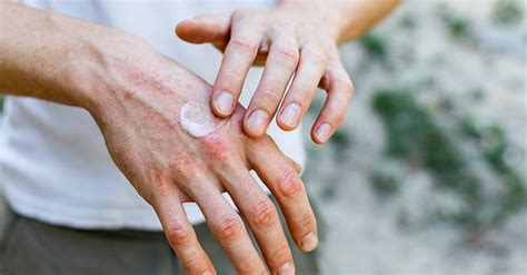 Do You Have Dry Skin On Your Hands Here Are Some Quick Methods For