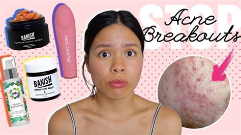 5 Mistakes That Make Your Acne Worse Youtube