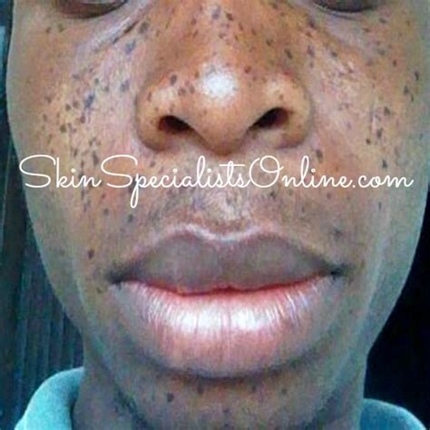 Dermatosis Papulosa Nigra Skin Specialists Online