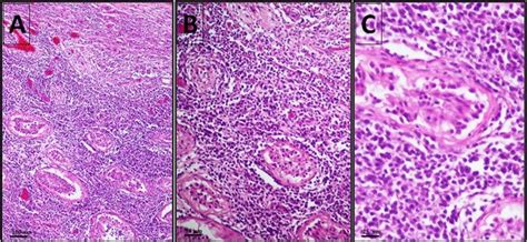 Testicular Invasion By Large B Cell Lymphoma At Different Download