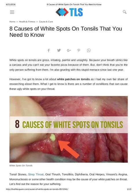 8 Causes Of White Spots On Tonsils That You Need To Know