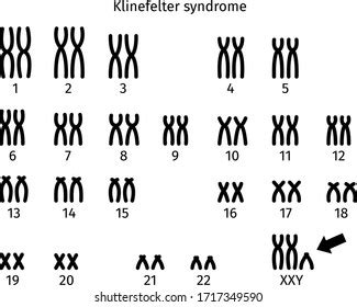 Schéma du syndrome de Klinefelter caryotype image vectorielle de