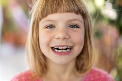 7 Signs Your Child Needs Braces Grafton Pediaatic Simply Orthodontics