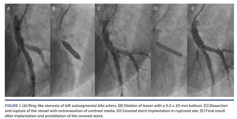 Rescue Implantation Of Covered Stent In Pulmonary Artery Rupture During
