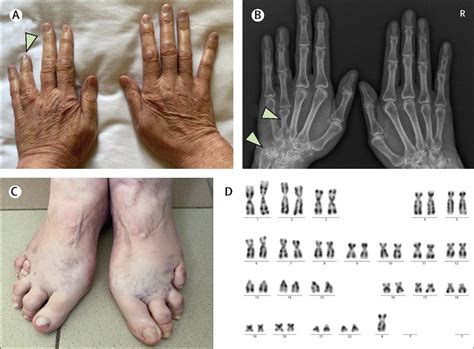 A Short Ring Finger Points To A Diagnosis Of Turner Syndrome Again