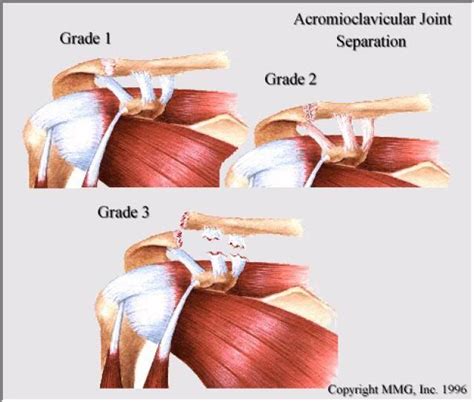 Common Causes And Treatments For A Separated Shoulder