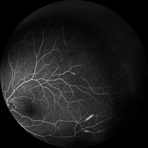 Moran Core Fundus Photography And Fluorescein Angiography Of Susacs