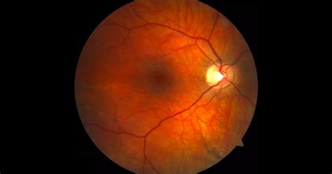 Blog Eye Specialists Centre Retina And Macula Cataract And Glaucoma