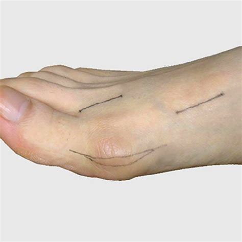 Incision Positions The Proximal Line Is For Metatarsal Basal