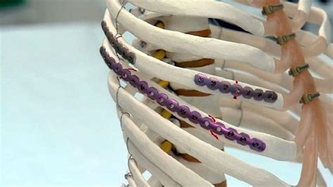 New Rib Plating Procedure Helps Patients Of Broken Ribs