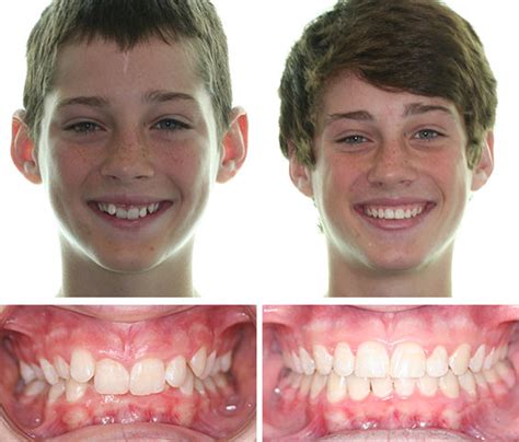 Before And After Photos Corbridge Orthodontics Frisco Tx