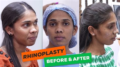 Amazing Nose Job Transformation Complete Rhinoplasty Experience Youtube