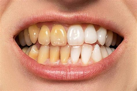 How To Whiten Yellow Teeth In Under Two Minutes Quick Fix