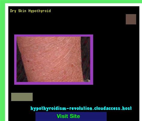 Dry Skin Hypothyroid 135041 Hypothyroidism Revolution