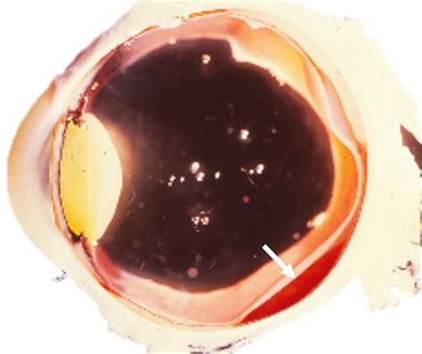 Enucleated Eye With Subretinal Hematoma Retina Image Bank